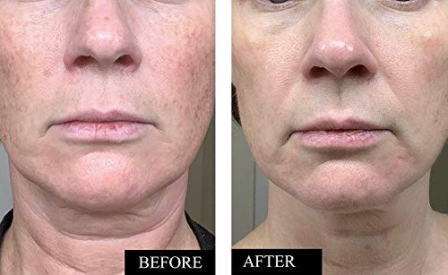 Kleem Anti-Aging Vitamin C Serum for Face - Brightening Serum for Dark Spots, Age Spots, Wrinkles & Sun Damage - Face Serum with Hyaluronic Acid, Vitamin E & Aloe Vera - Dermatologist Tested, 1.7oz