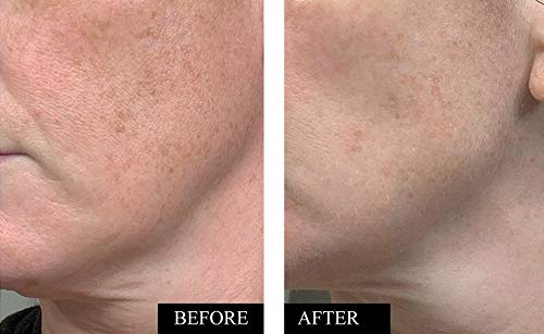 Kleem Anti-Aging Vitamin C Serum for Face - Brightening Serum for Dark Spots, Age Spots, Wrinkles & Sun Damage - Face Serum with Hyaluronic Acid, Vitamin E & Aloe Vera - Dermatologist Tested, 1.7oz