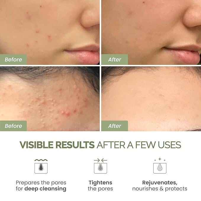 PLANTIFIQUE V-Line Collagen Mask for face 5 PCS | Chin Strap for Women & Men and Korean Skincare Clay Mask – Hydrating Mud Mask with Avocado & Superfoods