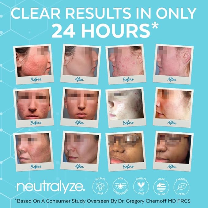 Neutralyze Moderate to Severe Acne Face Wash 2.0 - Maximum Strength 2% Mandelic Acid & 2% Salicylic Acid Facial Cleanser for Acne Prone Skin - Suitable for All Skin Types, Teens & Adults (5 FL OZ)
