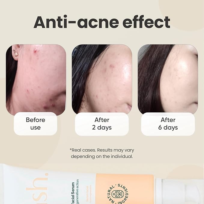 NSH Aloe & Hyaluronic Acid Face Serum 3.38 Fl oz – Ultra Hydrating, Anti-Aging & Anti-Acne Formula with Aloe, HA, Collagen, Elastin, Vitamin B5 & Vitamin E for Plumper, Clearer, Rejuvenated Skin