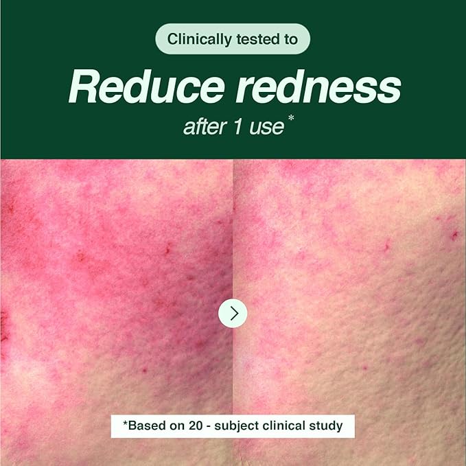 Tea Tree Foam Cleanser – Gentle Daily Face Wash for Acne-Prone & Sensitive Skin, Helps Soothe Redness and Hydrate, Formulated with Tea Tree and Cica, Korean Skin Care (5.07 fl oz)