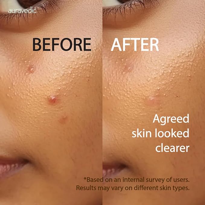 Auravedic Acne Face Wash with 2% Salicylic Acid, Neem & Tea Tree | Foaming Cleanser for Oily & Acne Prone Skin | Oil Control, Gentle Daily Cleanser for Men & Women | 4.06 Fl Oz (120ml)