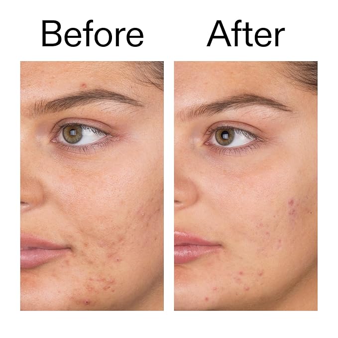 The INKEY List Salicylic Acid Cleanser - Daily Exfoliating Cleanser with 2% Salicylic Acid & Zinc PCA, Unclogs Pores, Anti Acne, Reduces Blackheads & Excess Oil for Clearer Skin
