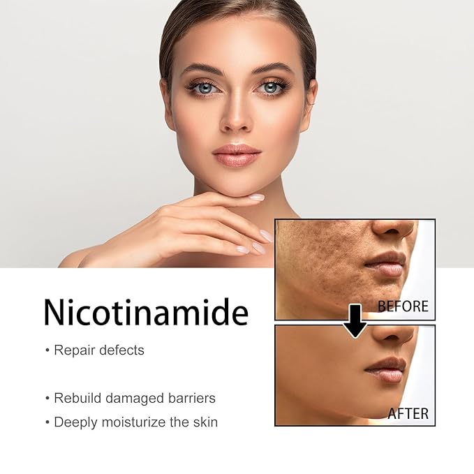 Generic Niacinamide Freckles Removal Serum, Sunnylas Niacinamide Freckles Removal Serum, Niacinamide Serum for Face and Body, Nicotinamide Serum for Blemishes, for All Type Skin (3PCS)