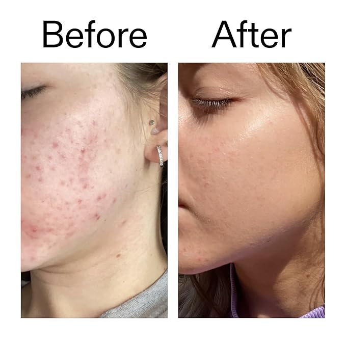 The INKEY List 10% Niacinamide Serum, Lightweight Oil Control Serum Helps with Blemishes and Appearance of Redness, Hydrating 1% Hyaluronic Acid 30ml, 1 fl oz