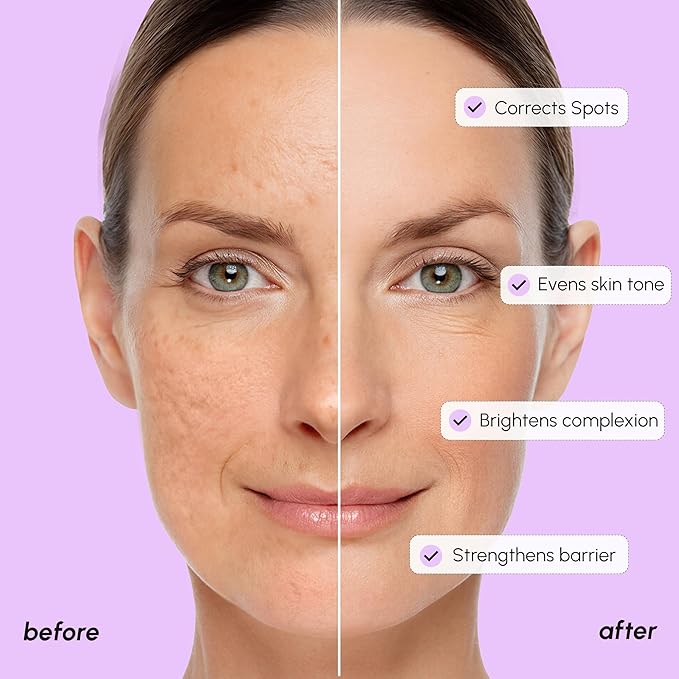 MAREE 20% Tranexamic Acid Serum Complex with Niacinamide & Vitamin C – Serum for Face & Body Dark Spot Corrector – Age Spots Hyperpigmentation Care Remover – Brightening Acido Tranexamico para Manchas