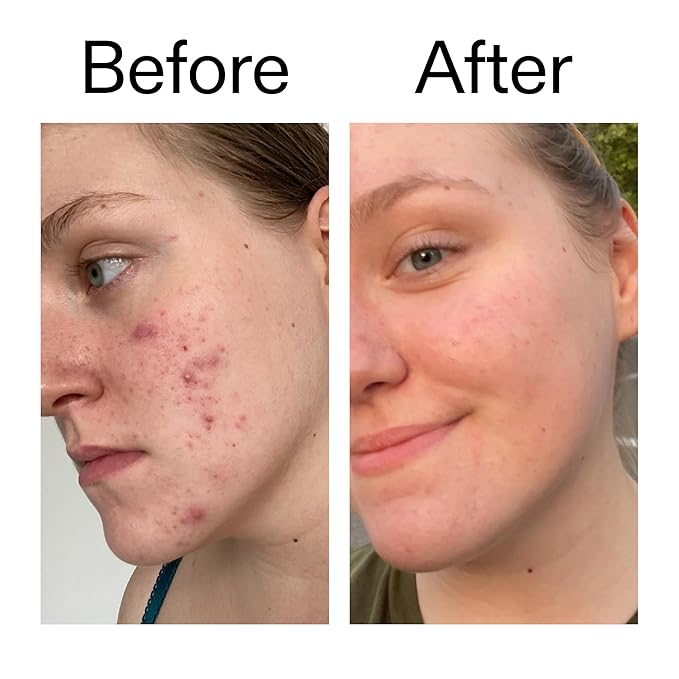 The INKEY List 15% Vitamin C and EGF Serum 1 Fl Oz, Reduces Hyperpigmentation, Rejuvenating Skin Care, Vegan Friendly, Suitable For All Skin Types