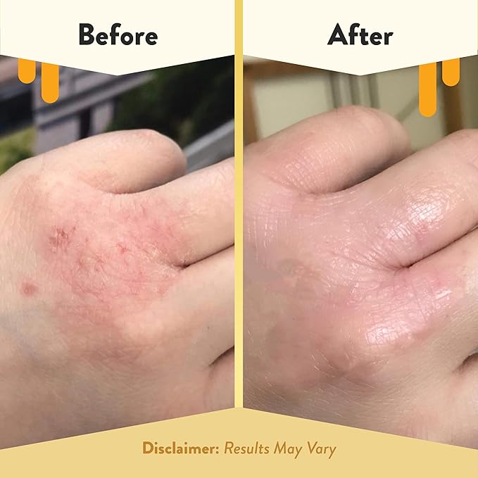 ECZEMA HONEY Original Skin-Soothing Cream - Organic Hand & Body Eczema Relief - Natural Honey Lotion for Dry, Itchy, & Irritable Skin (4 Oz) (Pack of 2)
