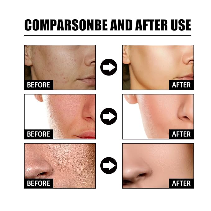 Generic Niacinamide Freckles Removal Serum, Sunnylas Niacinamide Freckles Removal Serum, Niacinamide Serum for Face and Body, Nicotinamide Serum for Blemishes, for All Type Skin (2PCS)