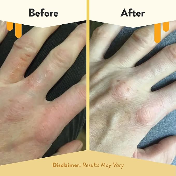 ECZEMA HONEY Oatmeal Hand Cream - Natural Hand & Body Lotion for Eczema Rash Relief - Eczema Cream for Dry, Itchy, Sensitive, & Irritable Skin (2 Oz) (Pack of 2)