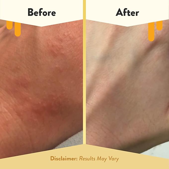 ECZEMA HONEY Oatmeal Body Lotion - Hand & Body Cream for Eczema Relief - Natural Dry Skin Repair (16 Oz) (Pack of 2)