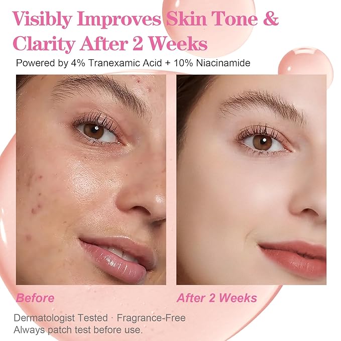 Niacinamide Serum 10% + Tranexamic Acid Serum 4%, Arbutin 2%, Hyaluronic Acid, Hydrating and Clarifying Facial Serum for Smooth, Radiant Looking Skin, Uneven Tone Care (30ml /1.01 fl.oz)