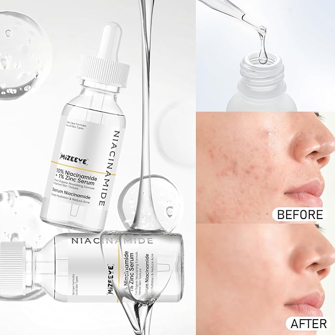 Niacinamide 10% + Zinc 1% Face Serum for Women, 2 PCS Refreshing Niacinamide Facial Serum For Acne.