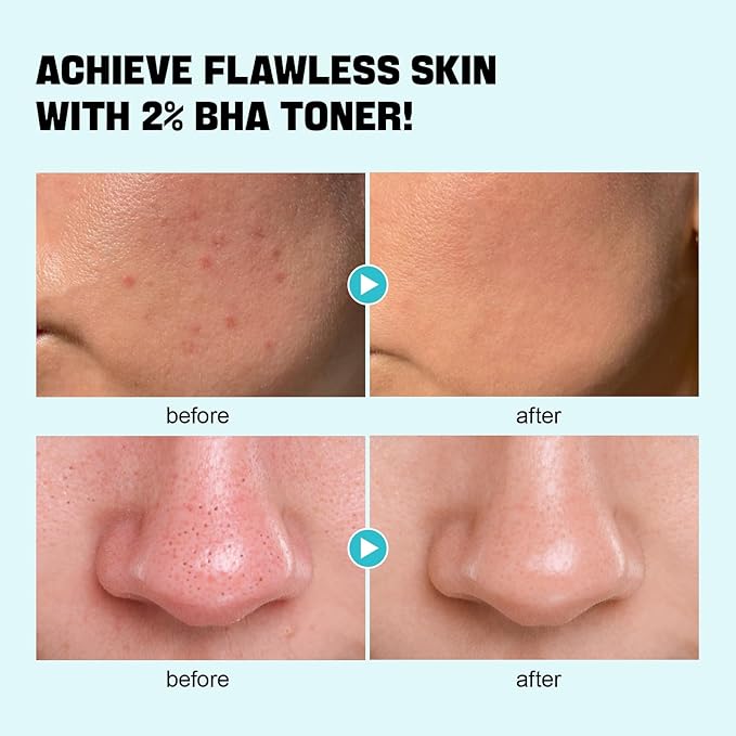ZealSea Salicylic Acid Toner, Blackhead Remover, BHA Liquid Exfoliant (CICA, 6.76OZ), Pore Minimizer for Face, Gentle Alcohol Free BHA Toner for All Skin Type with Niacinamide, Redness Relief, Vegan