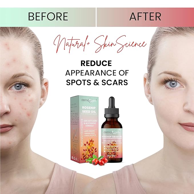 Rosehip Seed Oil 2 Fl Oz -100% Organic & Cold Pressed - Anti-aging Moisturizing Treatment For Face, Hair, Skin & Nails, Acne Scars, Anti-wrinkle.