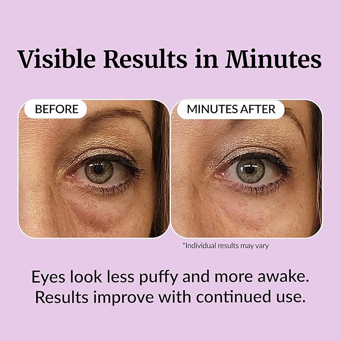 Vibriance Eye Renewal Serum for Mature Skin - Dark Circles, Puffiness & Fine Lines Treatment - 6 Advanced Ingredients with Caffeine & Hyaluronic Acid