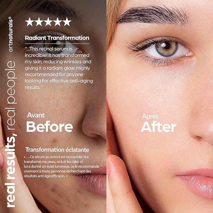 ArtNaturals Retinol Serum for Face - with Vitamin C, 2.5% Retinol Oil & Hyaluronic-Acid - Skin Clearing - Anti-Aging, Anti-Wrinkle Eye Serum - Skin Repair, Night Therapy (1 Fl Oz / 30ml) (ANGA-0127)