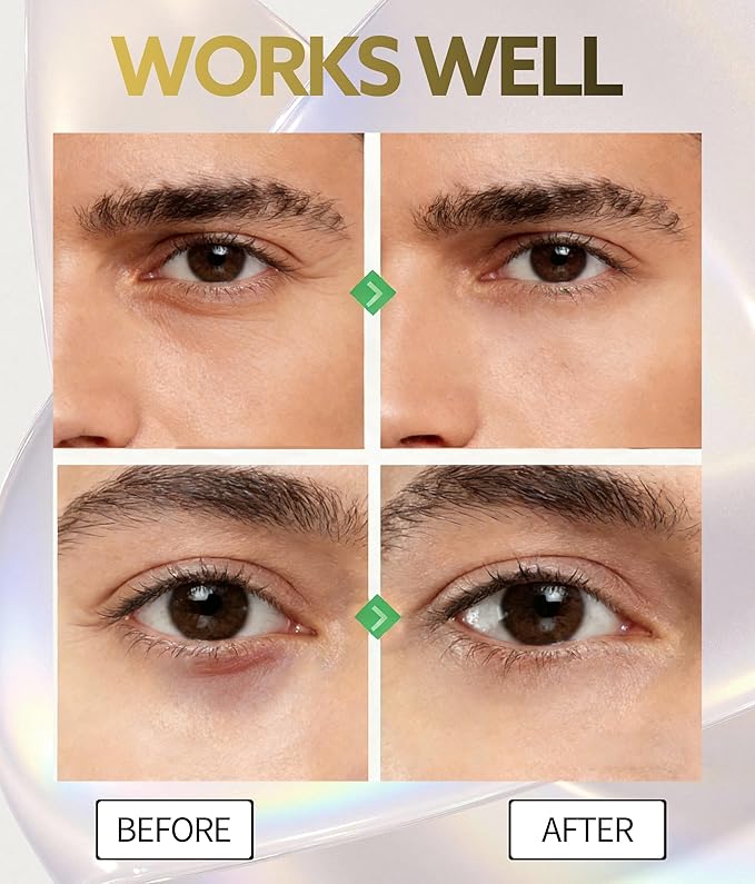Eye Bags Treatment for Men and Women, Caffeine Eye Cream with Roller for Dark Circles & Puffiness, Anti Aging Formula with Hyaluronic Acid, Retinol & Niacinamide to Reduce Wrinkles and Fine Lines